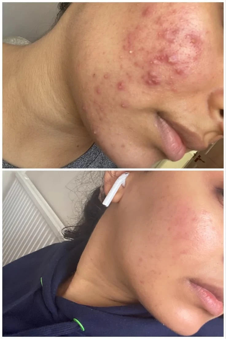 Kobayashi Medicated Atnon Acne Scar Care Gel - Best for Fading Pimple Marks (10g)