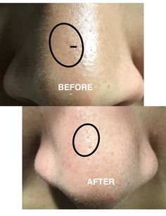 RiRe - All Kill Blackhead Remover Stick 10g